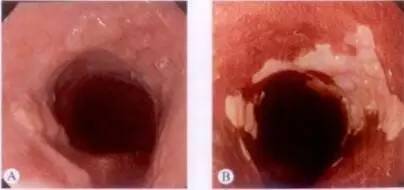 早期食管癌用内镜可以根除吗,超声内镜可以查出早期食管癌吗