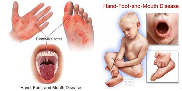 手足口病最新诊疗指南,重症手足口病最佳治疗方法