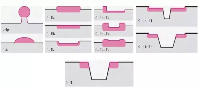 早期食管癌用内镜可以根除吗,超声内镜可以查出早期食管癌吗