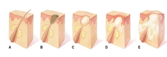 CiCi年希老师：闭口粉刺是什么？那么多人分不清楚它和痘痘的关系