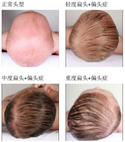 月嫂怎么给宝宝睡头型,月嫂带过的宝宝头型