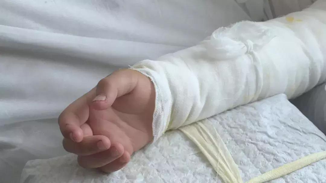 女婴被开水严重烫伤众人伸出援手,7岁女孩高速爱心接力