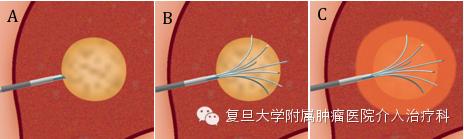 冰火两重天治疗,冰火两重天中医