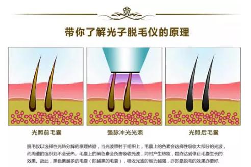 这几种脱毛方式供你选择夏天拒绝做“金刚”少女！