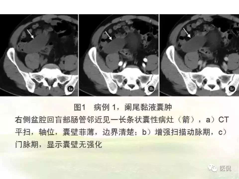 阑尾的解剖和影像表现,阑尾炎的32种鉴别诊断