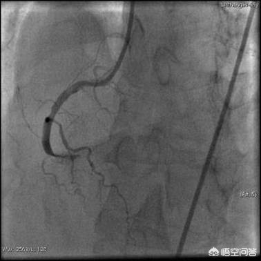 心脏有三根大血管,堵死一根还能正常工作吗?