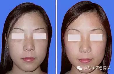 激光祛斑小贴士,极q激光祛斑