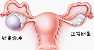 有好多小囊肿影响怀孕吗,小小的囊肿怎么治