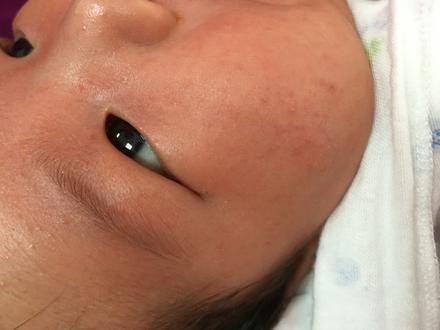 湿疹痱子用什么药比较有效,疹子上面有白点是痱子还是湿疹