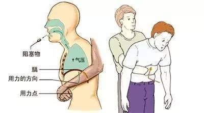 噎到了急救方法叫什么,噎到了急救方法自救