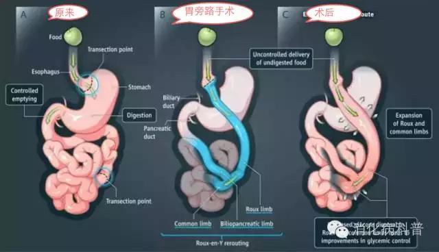 手术竟然可以治愈糖尿病
