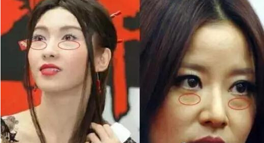 解决眼袋只需要三步,有眼袋不要慌用这个方法简单实用