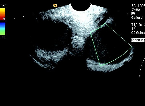 卵巢巧克力囊肿的分型不正确的,怎么辨别是不是卵巢巧克力囊肿
