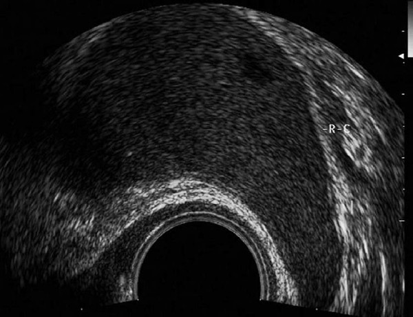 医学微视慢性盆腔炎,2023年盆腔炎检查报告单图片