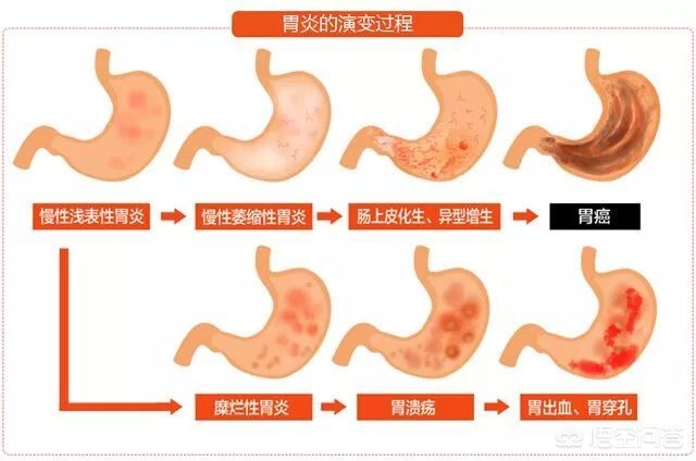 胃镜肠上皮化生是怎么回事,胃镜提示上皮肠化