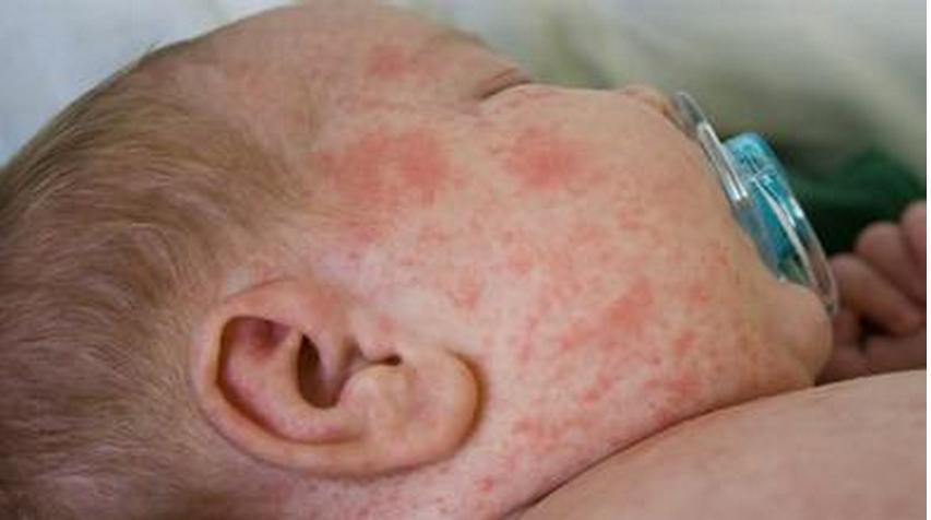 宝宝长痱子用什么最有效的方法,小孩脖子长痱子怎么解决