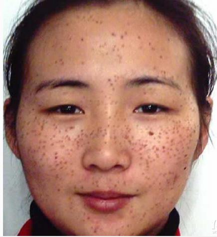 5分钟快速祛斑方法,祛斑知识