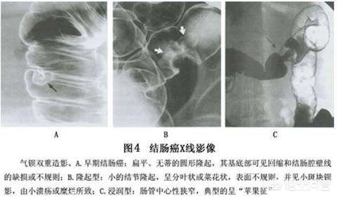 右肾15mm结节如何区分良性与恶性,4mm的实性结节怎样鉴别良性或恶性