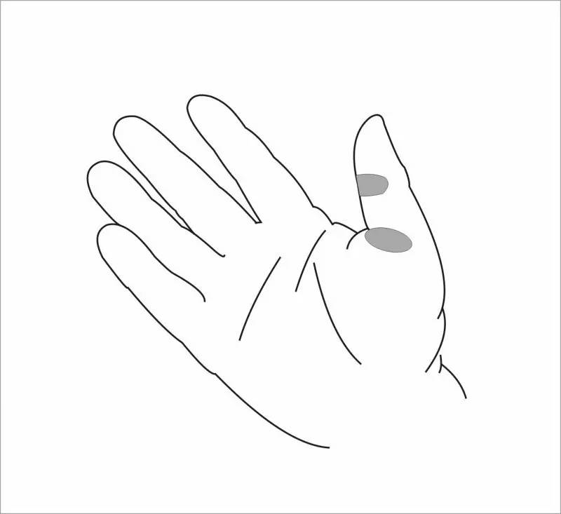 “哪有好医生?”之为什么人人都会得的腱鞘炎,治不好?