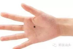 点痣会引发痣癌变吗,痣旁边长了小痣是不是癌变