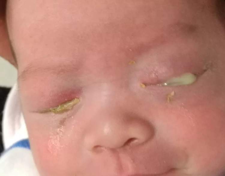 小孩眼红流泪有眼屎用什么滴眼液,孩子眼红有眼屎眼睛痒怎么办