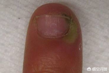 治疗肺癌的靶向药有副作用吗,靶向药对肺癌的治愈率