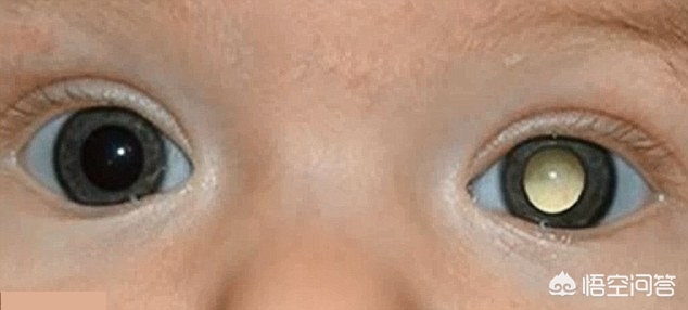 先天性视网膜母细胞瘤可以治疗吗,1岁多宝宝得了视网膜母细胞瘤