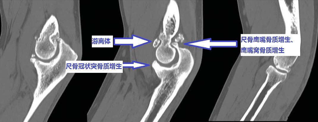 20年前肘关节伸不直,肘关节顶住墙怎么治疗