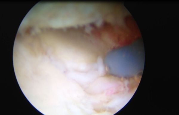 20年前肘关节伸不直,肘关节顶住墙怎么治疗