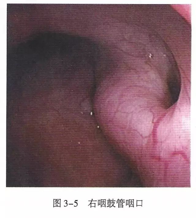 鍛煎惛閬撶殑瑙e墫缁撴瀯缁勬垚,涓嬪懠鍚搁亾瑙e墫瑙嗛鏁欑▼