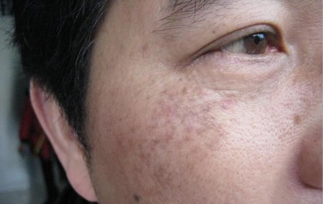 满脸斑淡斑并不难试试这个方法,淡斑小妙招长斑的女人快来看看吧