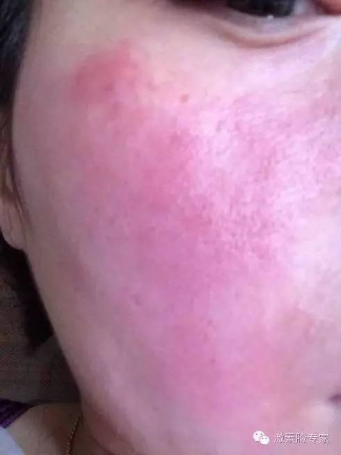 特应性皮炎夏天怎么办,夏天脂溢性皮炎怎么办