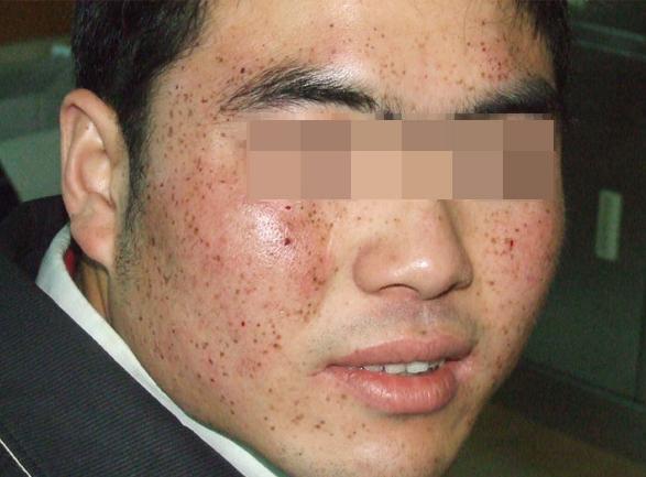 男性斑点怎么内调,男性褐斑怎么治