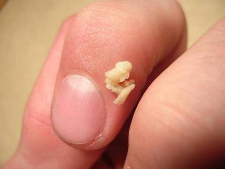 喉咙处有口臭是怎么回事,喉咙有异物感且伴有口臭