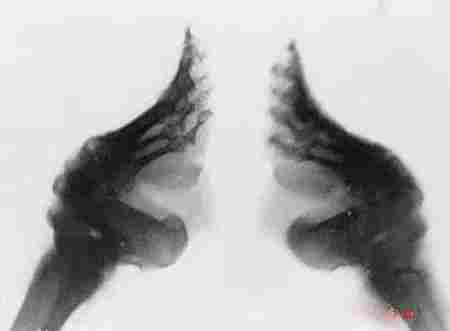 古代病态审美束腰裹脚,古代小脚畸形