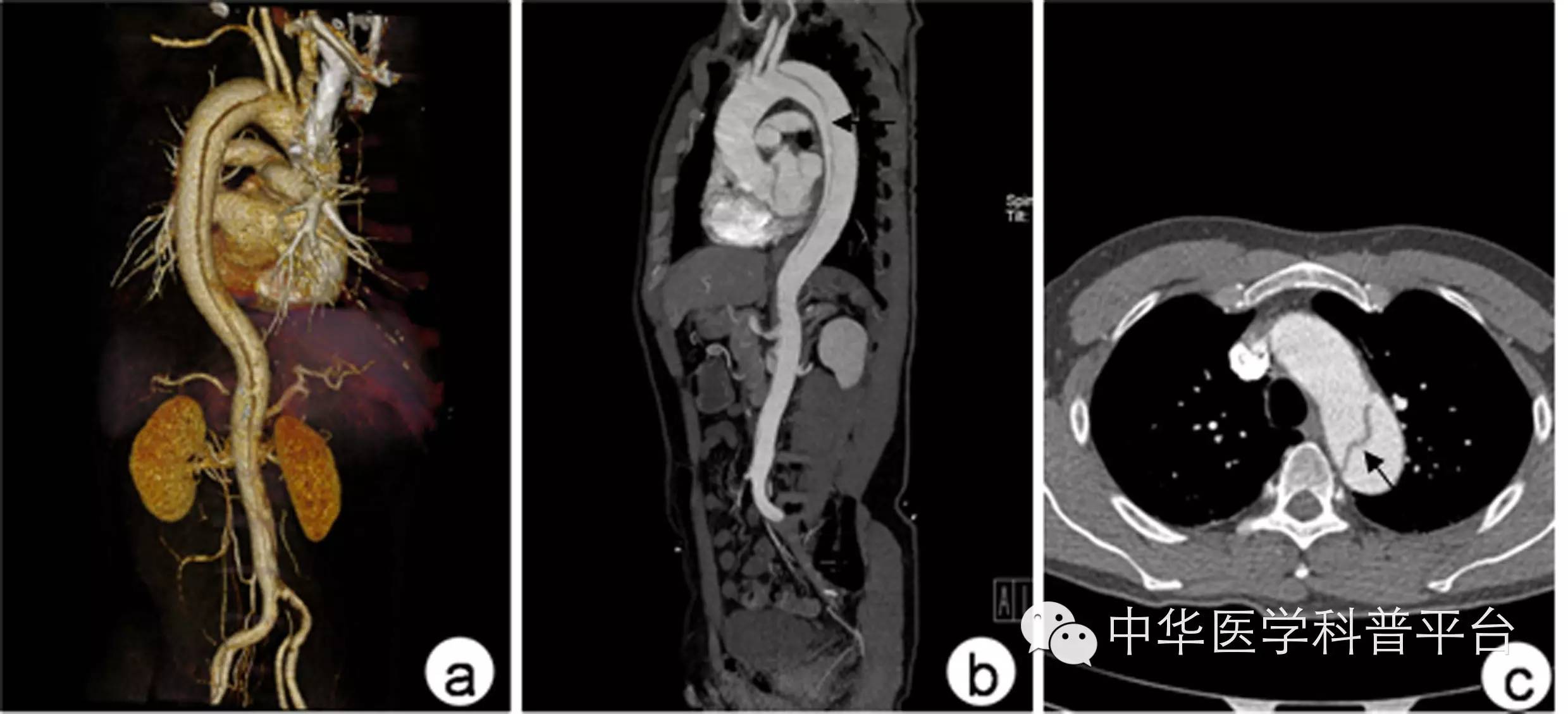主动脉夹层什么症状,心脏主动脉夹层破裂
