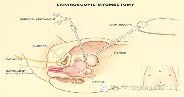 做了子宫肌瘤手术要多久可以备孕,专家解答子宫肌瘤