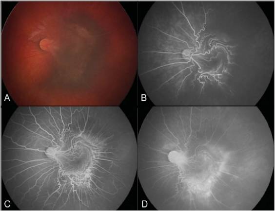 文摘速递儿童视网膜前膜手术的长期疗效