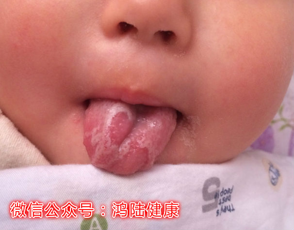 怎么确认宝宝是鹅口疮还是湿疹,婴幼儿鹅口疮症状