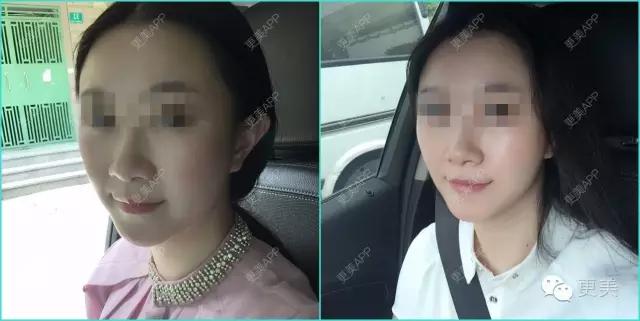 什么瘦脸霜最快最有效,瘦脸霜有用吗