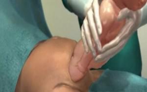 分娩时进行“剖腹产”手术全过程（附图）