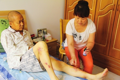 宫颈癌晚期引起尿毒症是由于什么,宫颈癌晚期并发尿毒症治好了