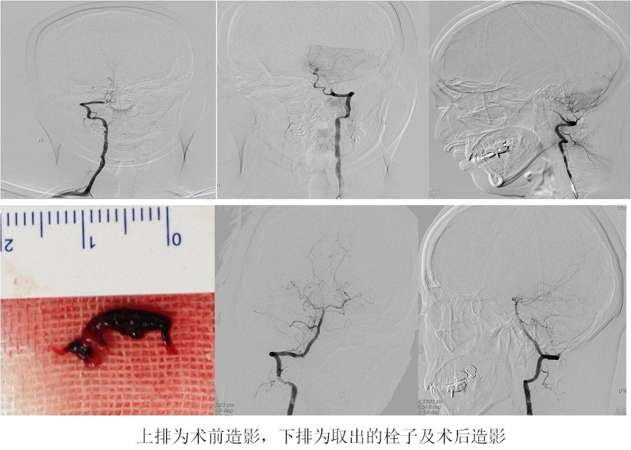 rt-pa溶栓的禁忌症,神经介入溶栓术联合静脉溶栓治疗