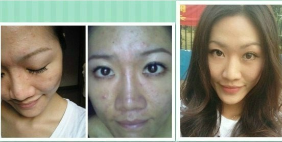 青春痘祛痘痕有效的方法,祛痘痕有效的方法有哪些