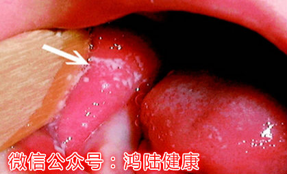 宝宝鹅口疮脸上长满红疹为什么,7个月宝宝鹅口疮最佳治疗方法