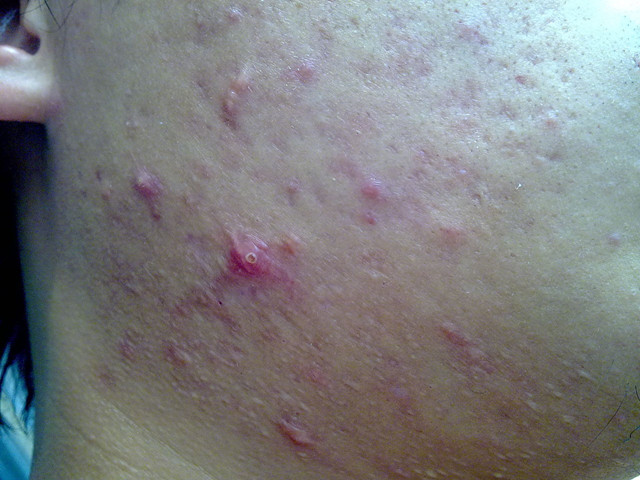 清上防风汤治疗粉刺医案,治疗粉刺的中药方