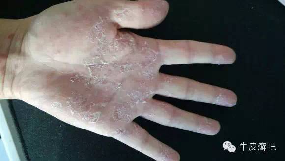 医院专家教你治疗牛皮癣,专家专治牛皮癣方法