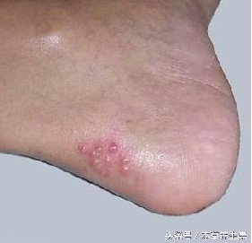 脚上脱皮红疱疹怎么根治,脚上反复起水泡脱皮开裂怎么治疗