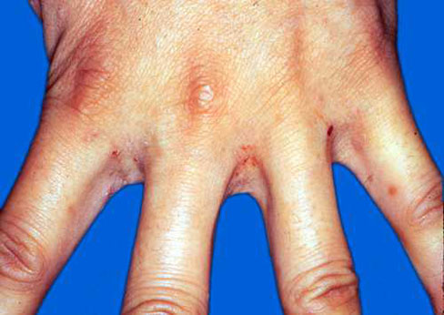 构树皮怎样治皮肤病,构树皮怎么用治皮肤病