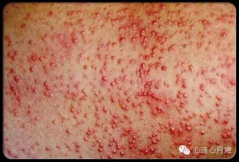 痱子跟湿疹能不能靠肉眼辨认出来,湿疹痱子傻傻分不清文章